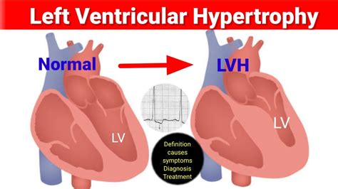 lv heartbeat|living with left ventricular hypertrophy.